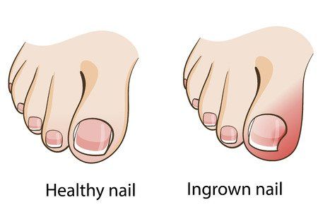 Nail dystrophy and foot pain | MDedge Family Medicine