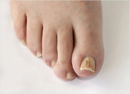 PACT® Fungal Nail Therapy | FootWorks