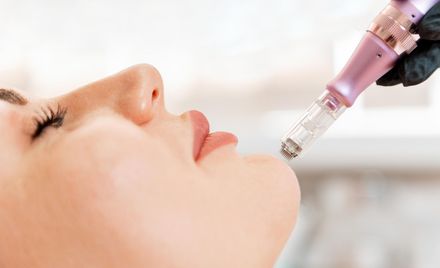 Woman receiving a facial treatment with a microneedling device close to her lips and chin