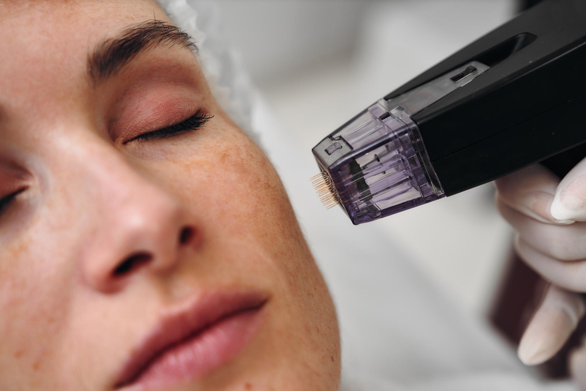 Close-up of a facial treatment device near a person’s cheek and closed eye, with a gloved hand holding it