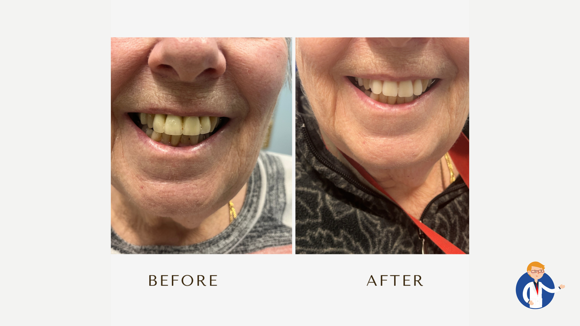 Side-by-side dental photos showing a person's teeth before and after treatment.