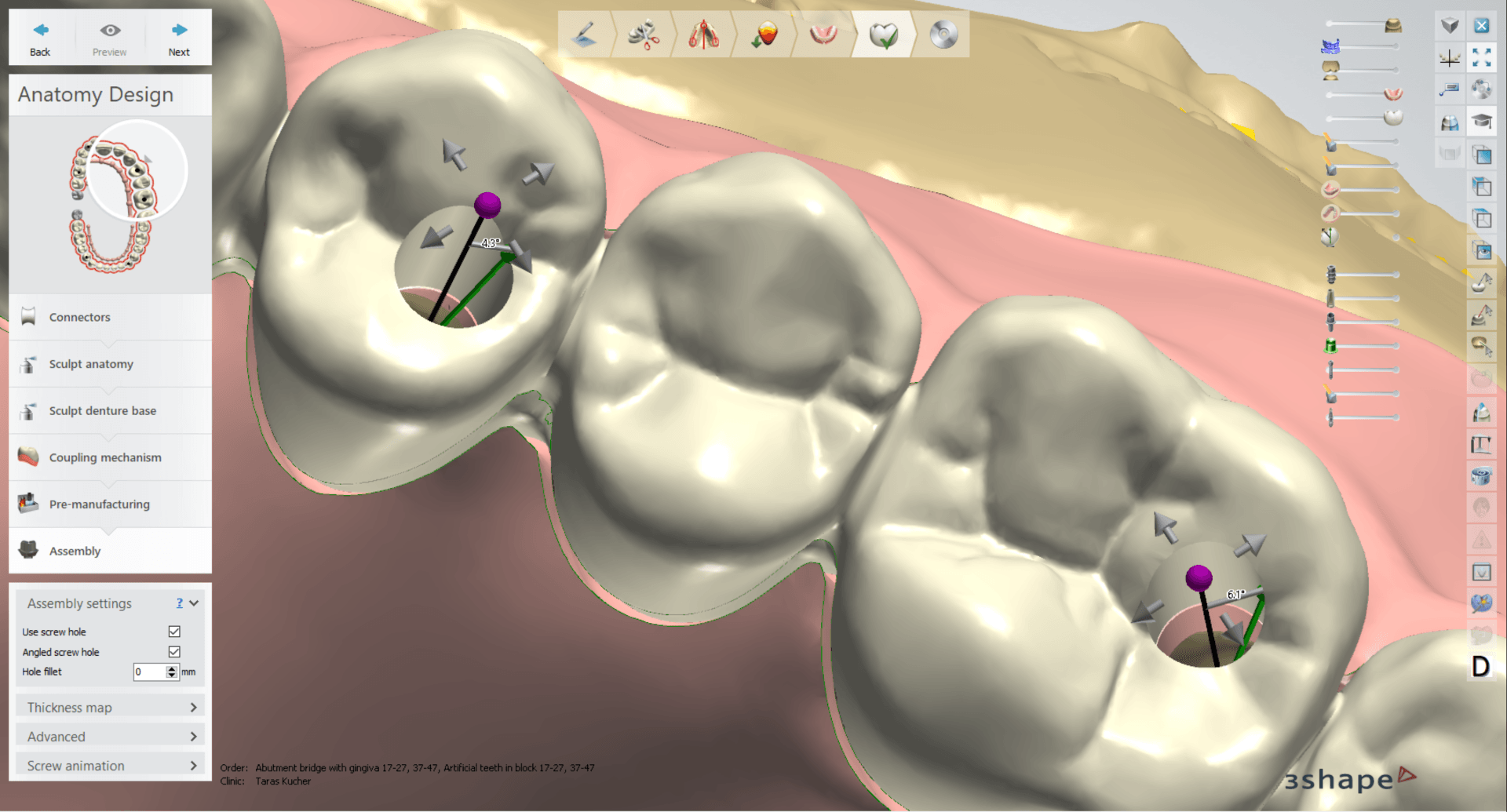 A computer screen shows a 3d model of a tooth.