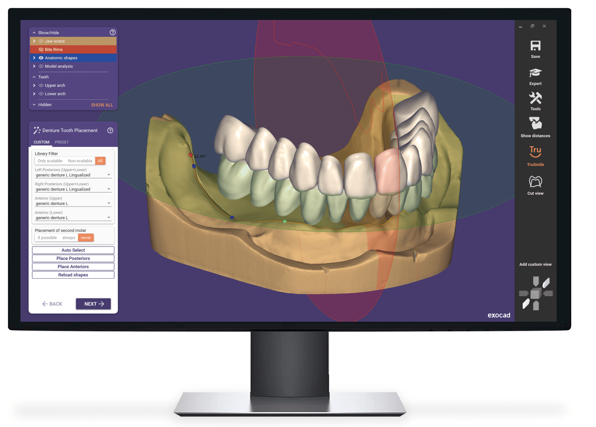 A computer monitor shows a model of a person 's teeth