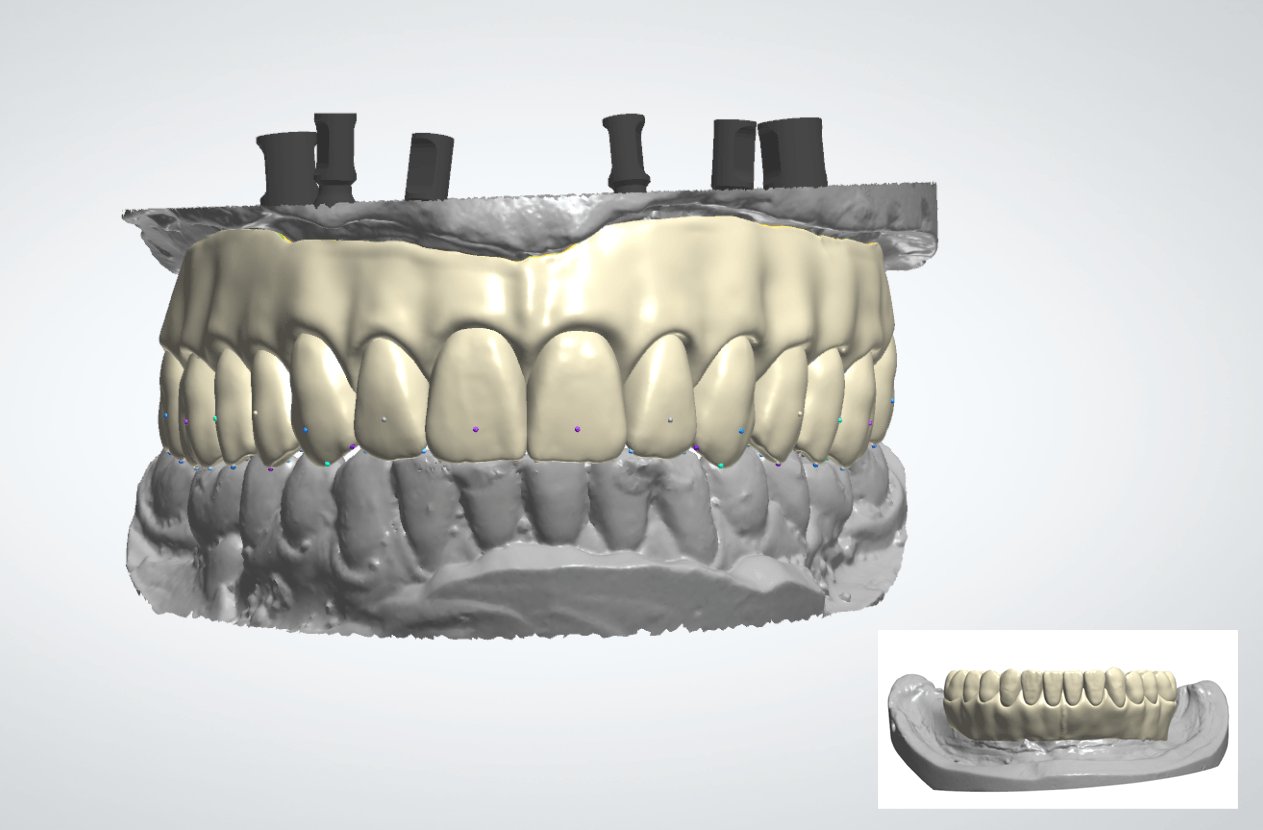 A 3d model of a person 's teeth is shown