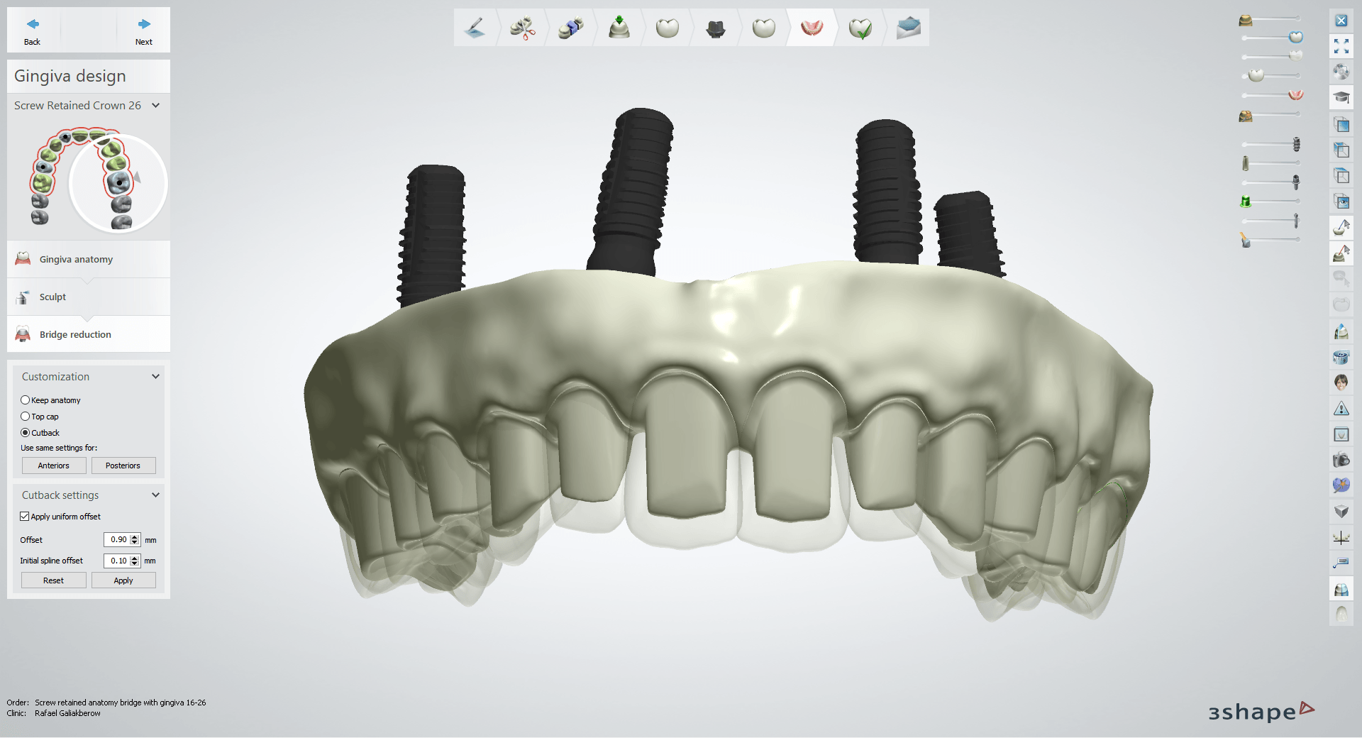 A computer screen shows a model of a person 's teeth