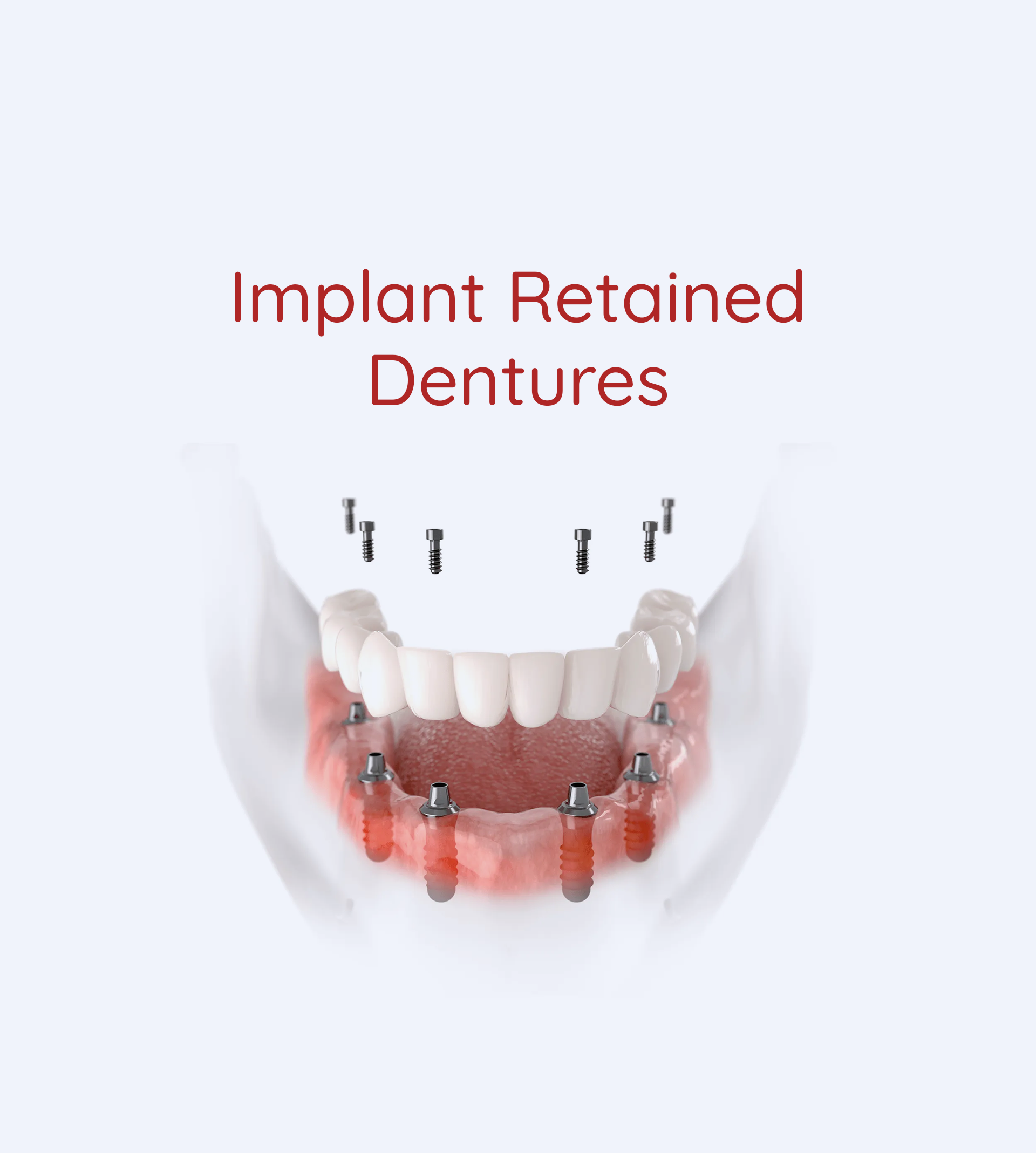 A picture of Implant Retained Dentures on a white background