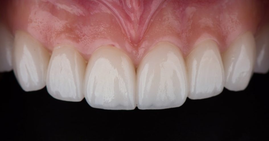 A close up of a person 's teeth with a black background.