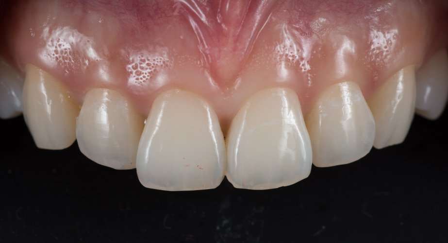 A close up of a person 's teeth with a black background.