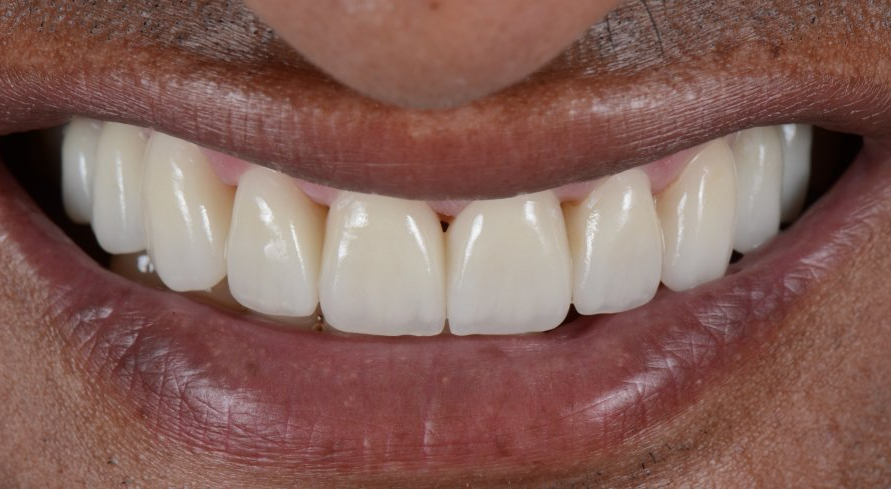 A close up of a man 's smile with white teeth.
