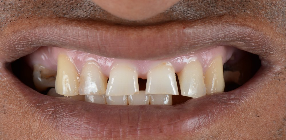 A close up of a man 's mouth with missing teeth.