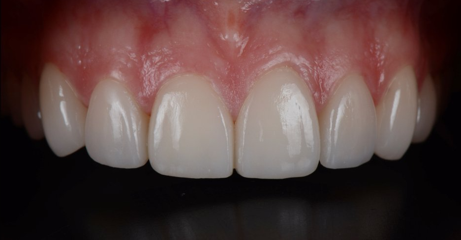 A close up of a person 's teeth with a black background.