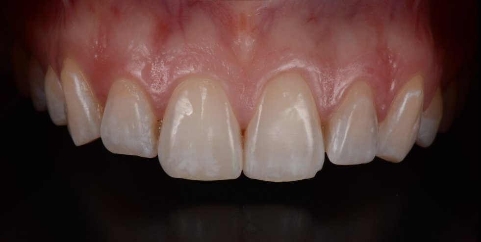 A close up of a person 's teeth on a black background.