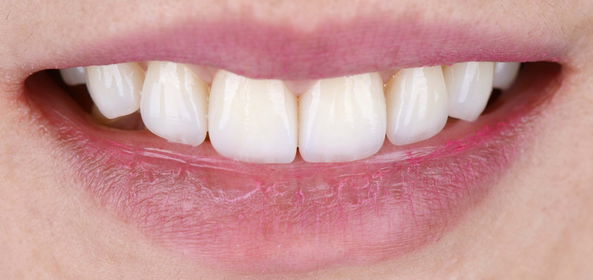 A close up of a person 's mouth with white teeth and pink lips.