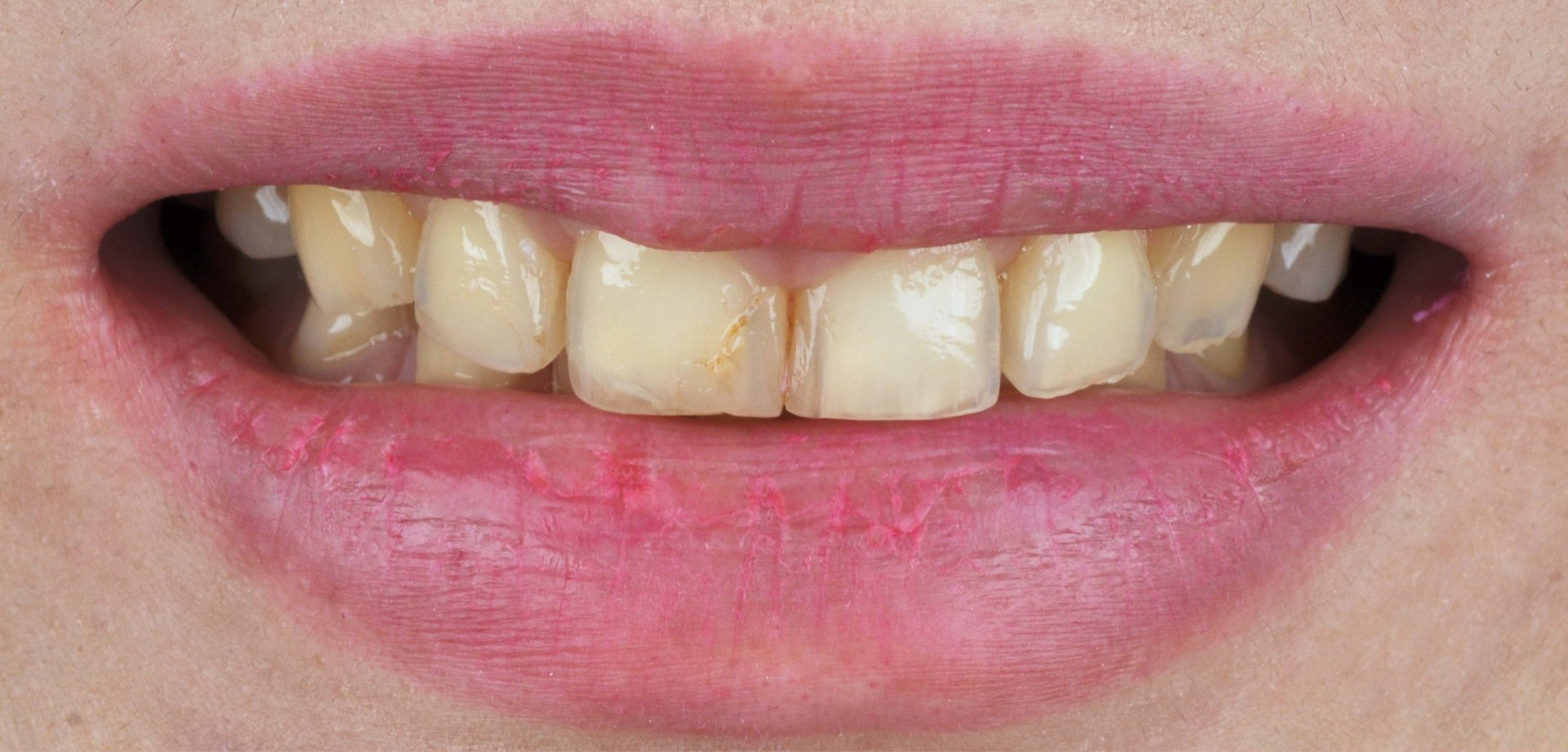 A close up of a person 's mouth with yellow teeth.