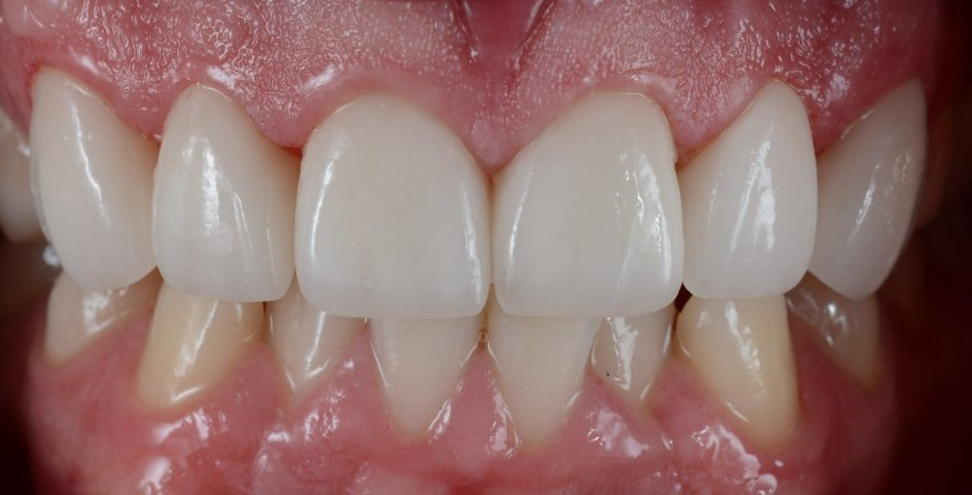 A close up of a person 's teeth with white teeth.