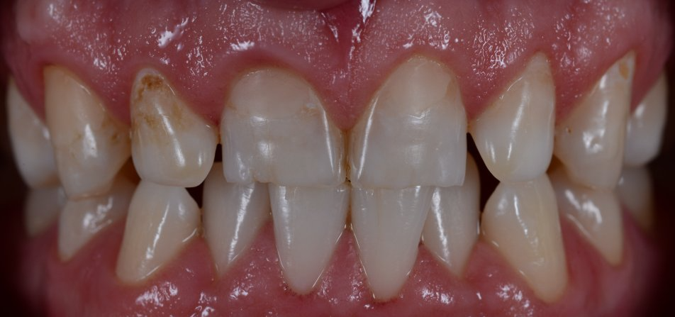 A close up of a person 's teeth with brown spots on them.