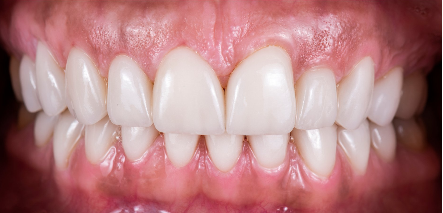 A close up of a person 's teeth with white teeth.
