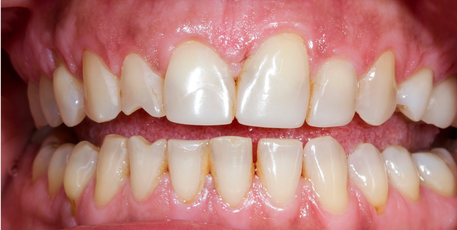 A close up of a person 's teeth with a missing tooth.