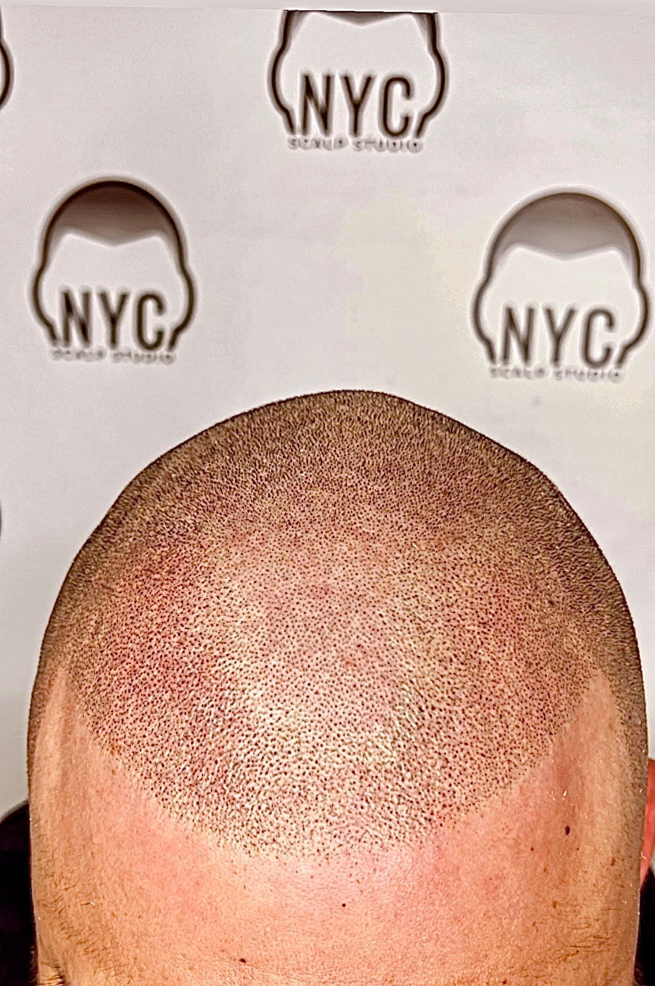 Scalp Micropigmentation Brooklyn, & New York City NY NYC Scalp Studio