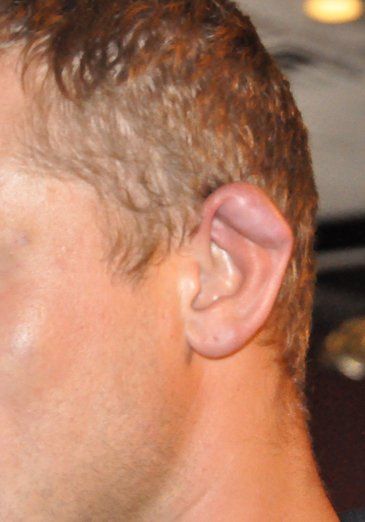 Image of cauliflower ear