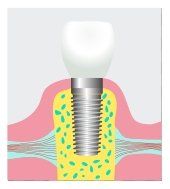 implant dentist in Flushing