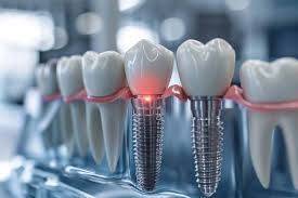 tooth implants in Flushing

