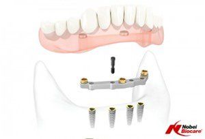 Dental Implant Bars