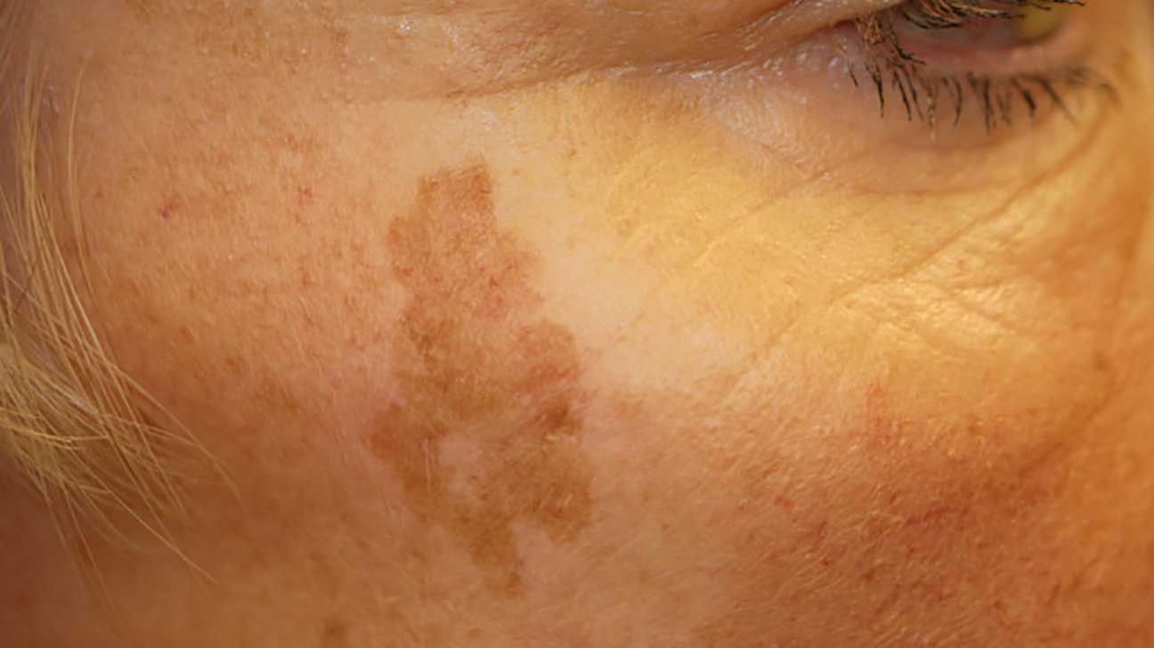 A close up of a person applying a serum to their face.
