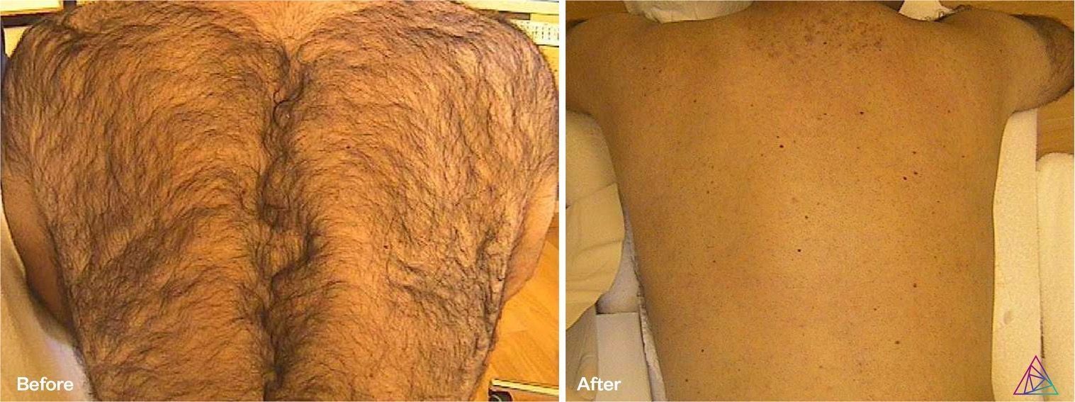 Comparison of a hairy back before and after hair removal treatment.