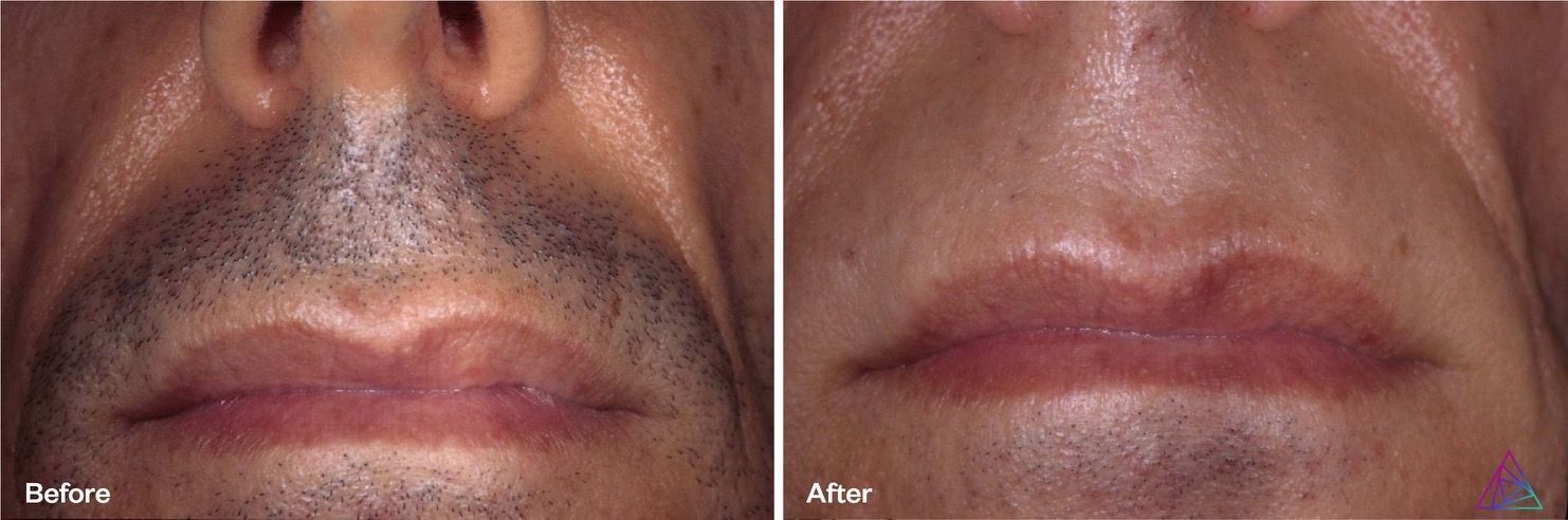 Before and after comparison of a person's upper lip, showing hair removal.