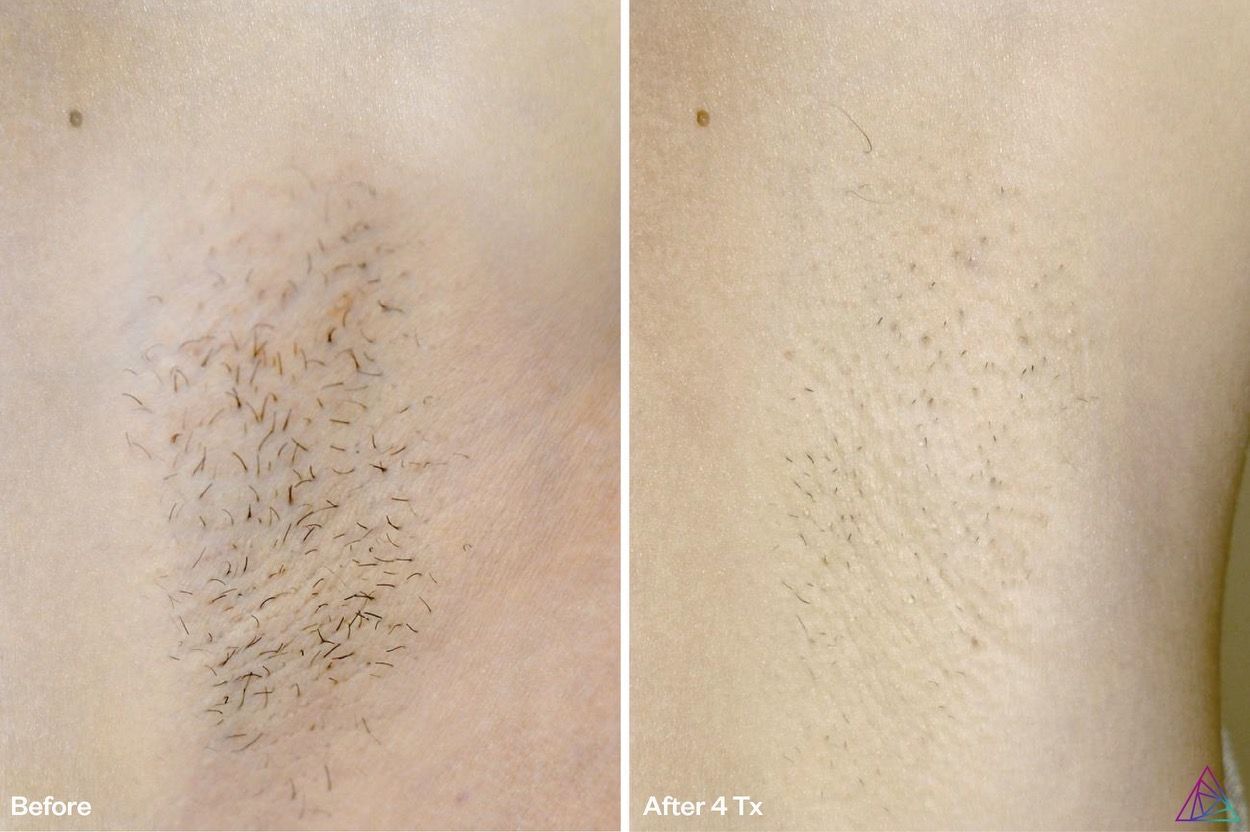 Comparison of an armpit with hair before and after four laser treatments.