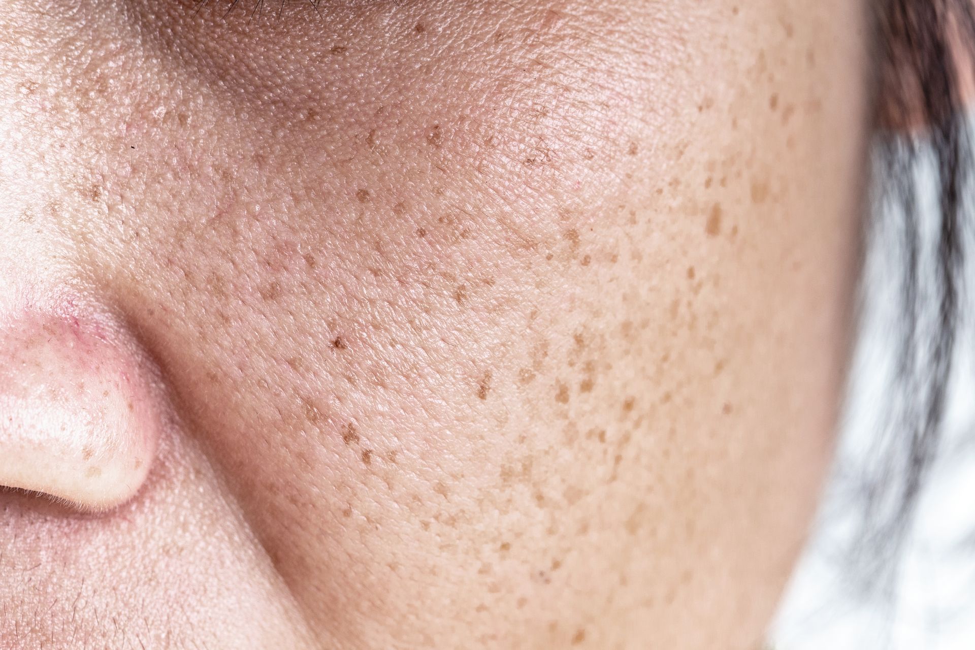 Close-up of skin with many small brown spots, likely sun damage.