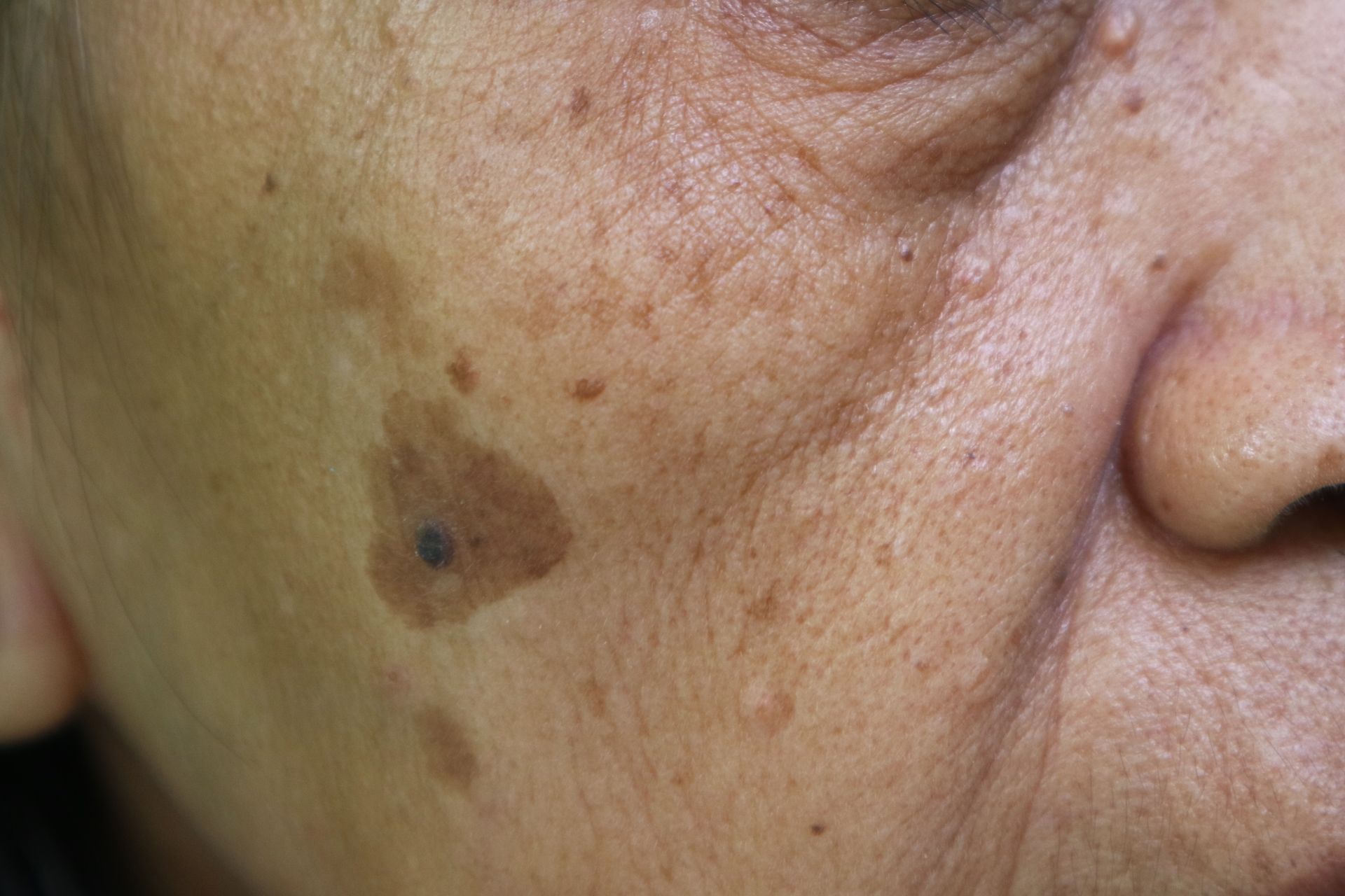 Close-up of a person's cheek with brown age spots and small moles.