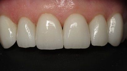 Porcelain veneers — Patient Teeth in Tewksbury, MA