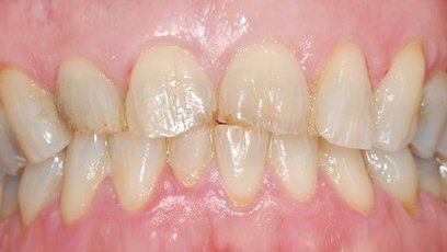 Worn down front teeth — Patient Teeth in Tewksbury, MA