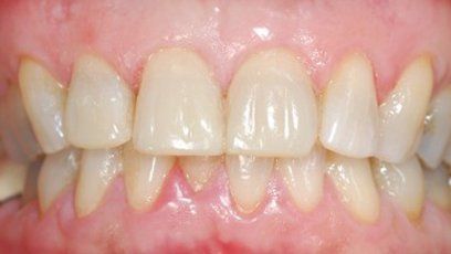 Porcelain veneers — Patient Teeth in Tewksbury, MA