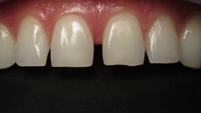 Spaces between front teeth — Patient Teeth in Tewksbury, MA