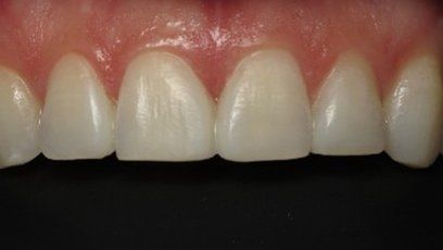 White filling — Patient Teeth in Tewksbury, MA