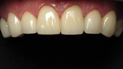 Strengthen teeth — Patient Teeth in Tewksbury, MA