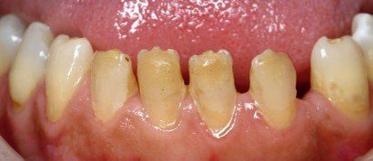 Open large spaces on teeth— Patient Teeth in Tewksbury, MA