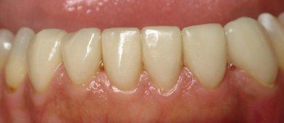 closed spaces on teeth— Patient Teeth in Tewksbury, MA