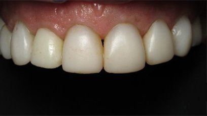 Front Teeth — Patient Teeth in Tewksbury, MA