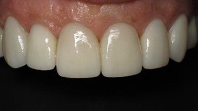 Porcelain Veneers — Patient Teeth in Tewksbury, MA