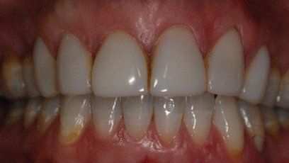Yellowish Teeth Patient Teeth in Tewksbury, MA