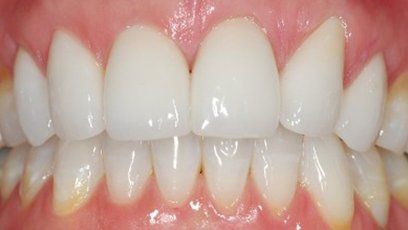 New porcelain crowns Patient Teeth in Tewksbury, MA