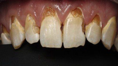 Cavities — Patient Teeth in Tewksbury, MA