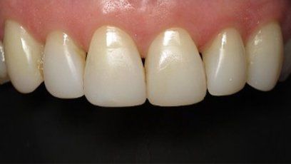 Worn down white fillings — Patient Teeth in Tewksbury, MA