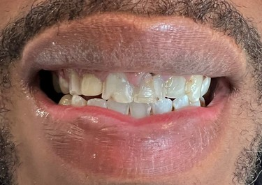 A close up of a man 's mouth with a beard showing his teeth.
