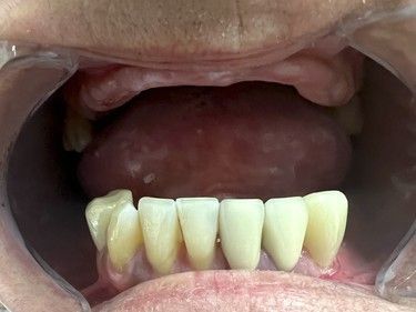 A close up of a man 's mouth with a beard showing his teeth.