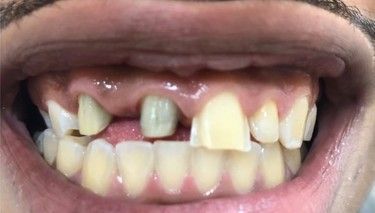 A close up of a person 's mouth with missing teeth.